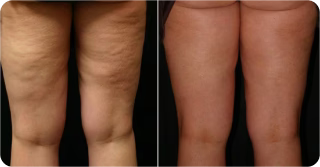 Tightique Cellulite Remover Massageapparat för Hud och Kroppsvård