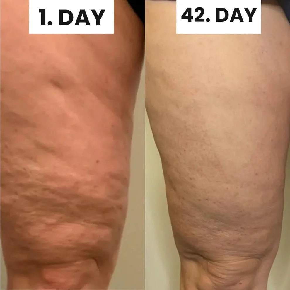 Tightique Cellulite Remover Massageapparat för Hud och Kroppsvård